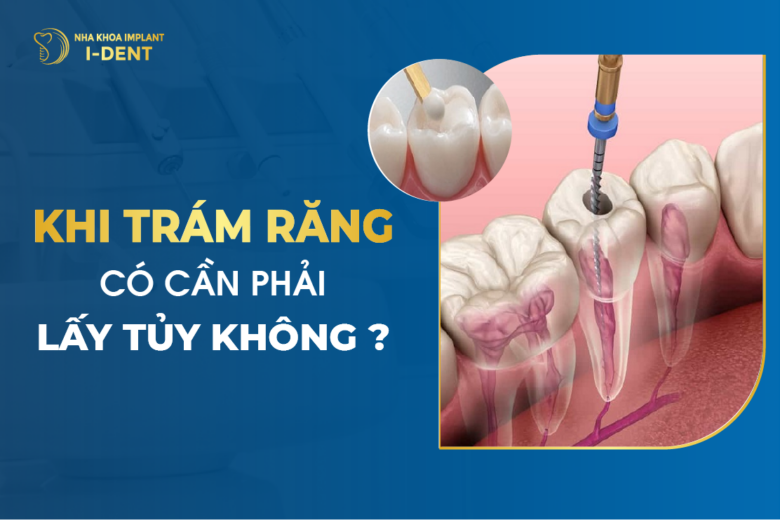 Khi Trám Răng Có Cần Phải Lấy Tủy Không?