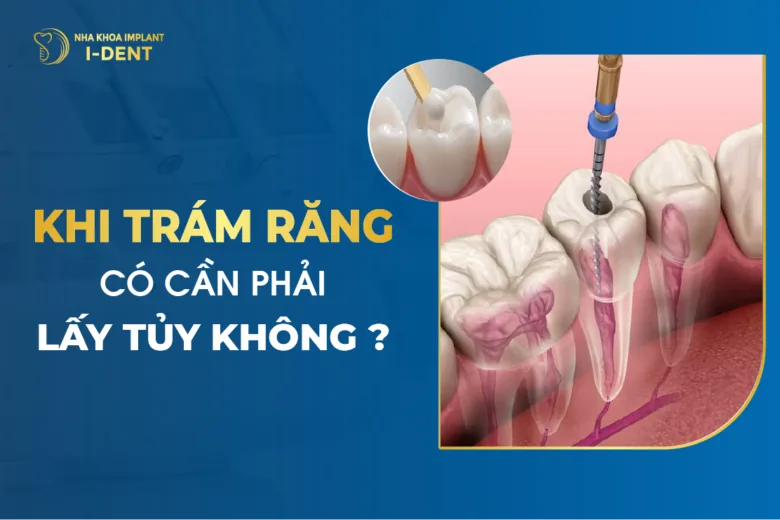 Khi Trám Răng Có Cần Phải Lấy Tủy Không