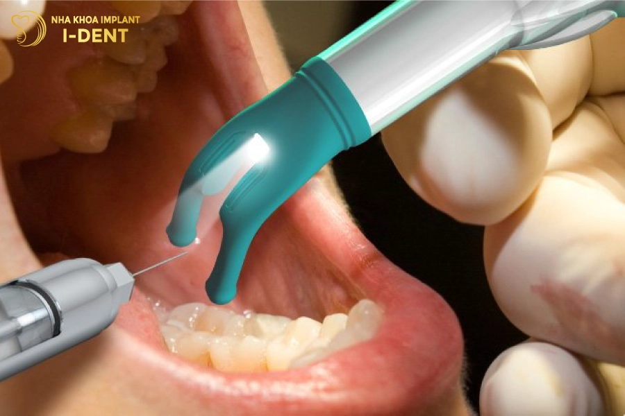 Khi nhổ răng bác sĩ sẽ tiêm tê nên bạn không phải lo lắng đau quá nhiều