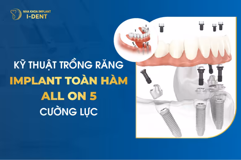 Kỹ Thuật Trồng Răng Implant Toàn Hàm All-on-5 Cường Lực