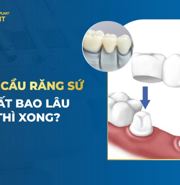 Làm Cầu Răng Sứ Mất Bao Lâu Thì Xong?