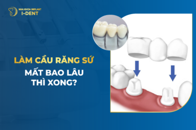 Làm Cầu Răng Sứ Mất Bao Lâu Thì Xong?