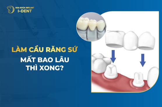 Bọc Răng Sứ Mất Bao Lâu Thì Xong? Nha khoa I-DENT