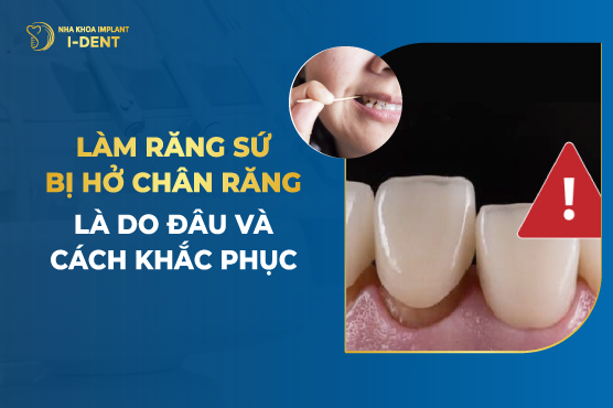 Dấu Hiệu Cầu Răng Sứ Bị Hở Và Cách Khắc Phục