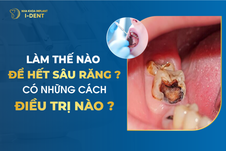 Làm Thế Nào Để Hết Sâu Răng? Có Những Cách Điều Trị Nào?