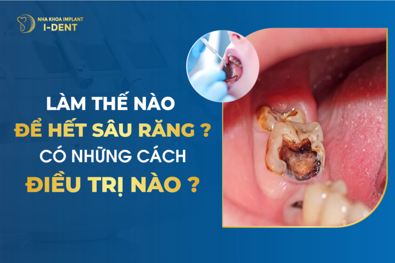 Làm Thế Nào Để Hết Sâu Răng? Có Những Cách Điều Trị Nào?