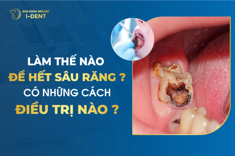 Làm Thế Nào Để Hết Sâu Răng? Có Những Cách Điều Trị Nào?