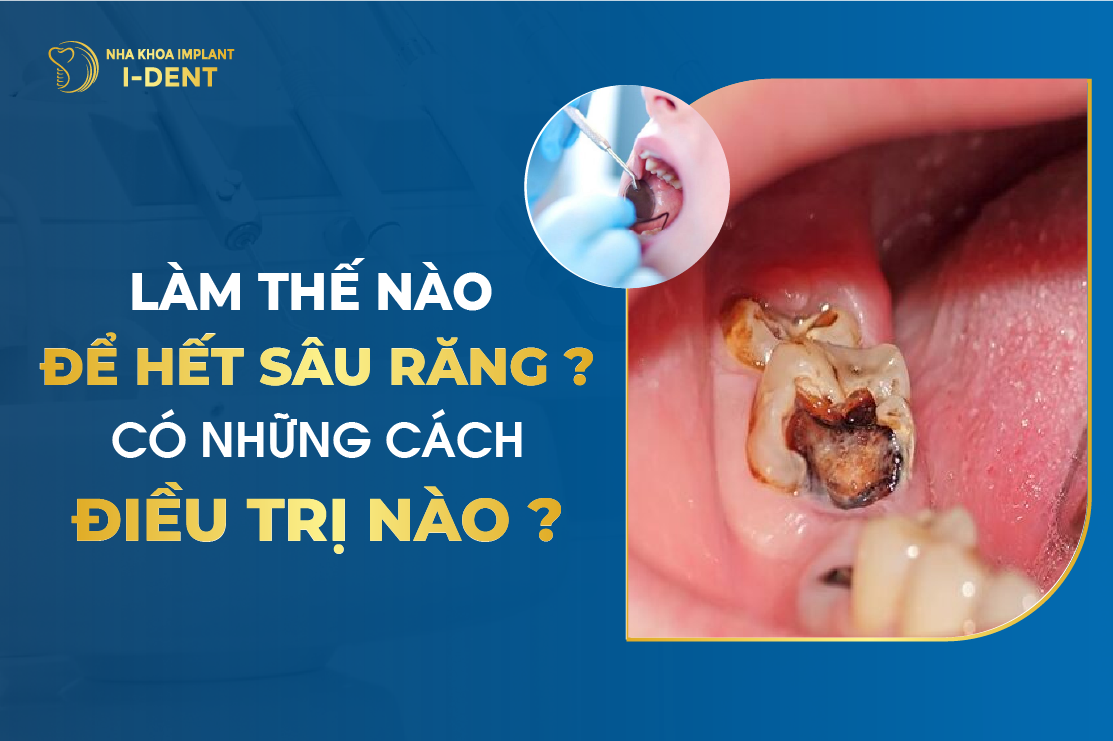 Nha sĩ khuyến cáo điều trị sâu răng bằng phương pháp nào là hiệu quả nhất?
