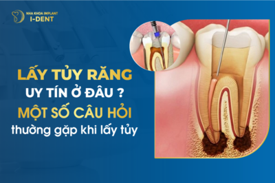 Địa Chỉ Chữa Tủy Răng Tại Tphcm Uy Tín Và Giá Rẻ Nhất