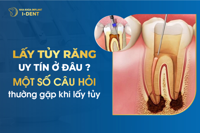 Địa Chỉ Chữa Tủy Răng Tại Tphcm Uy Tín Và Giá Rẻ Nhất
