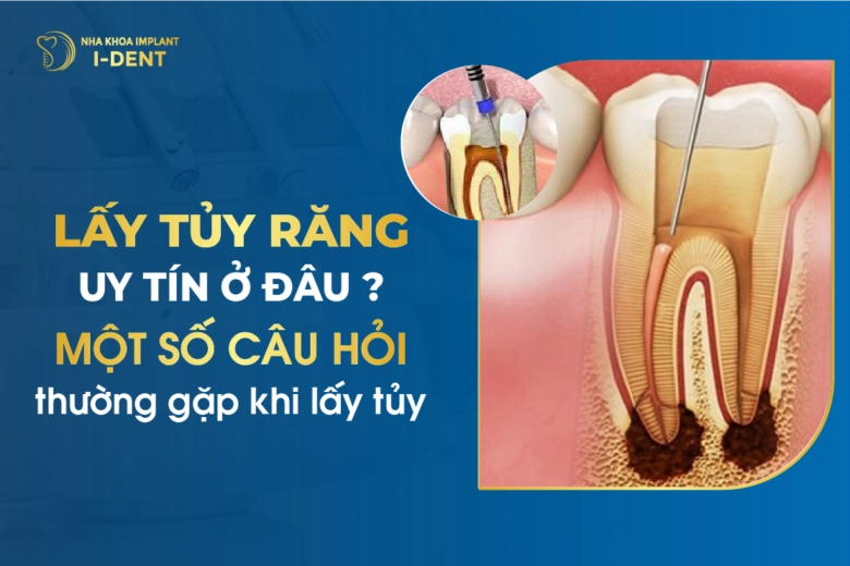 Địa Chỉ Chữa Tủy Răng Tại Tphcm Uy Tín Và Giá Rẻ Nhất