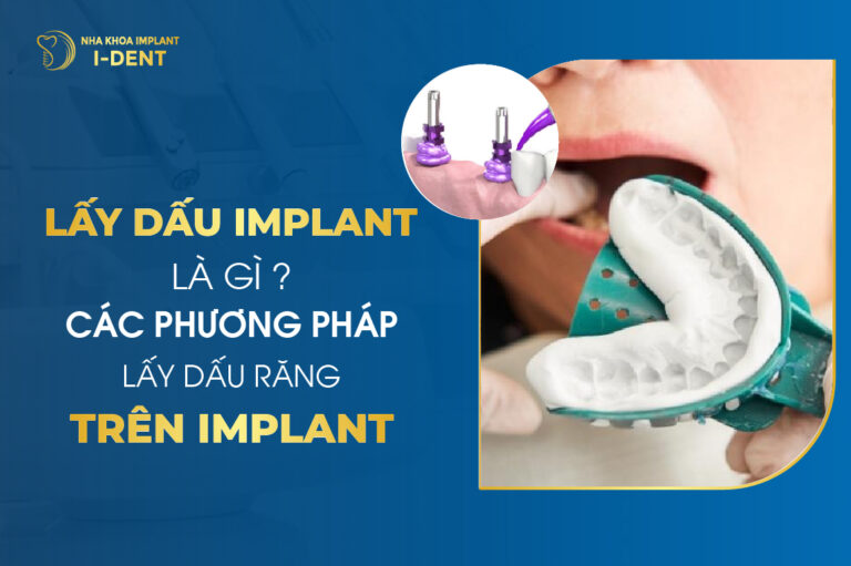 Lấy dấu implant là gì Các giải pháp lấy dấu răng trên implant