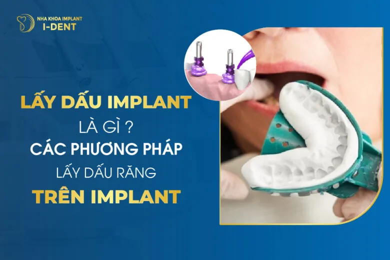 Lấy dấu implant là gì Các giải pháp lấy dấu răng trên implant