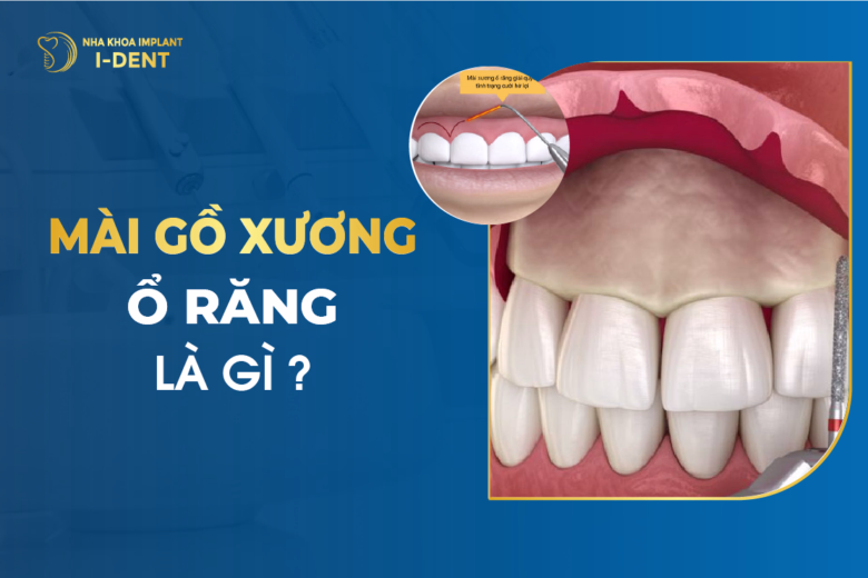 Mài Gồ Xương Ổ Răng Là Gì