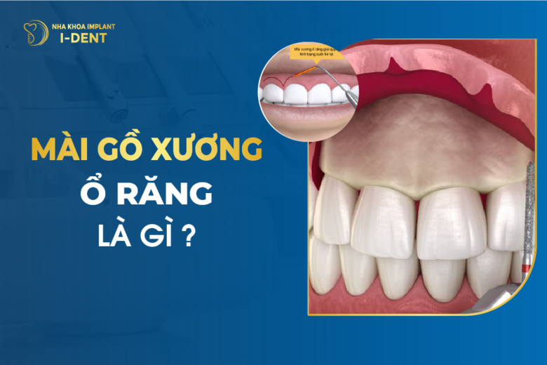 Mài Gồ Xương Ổ Răng Là Gì?