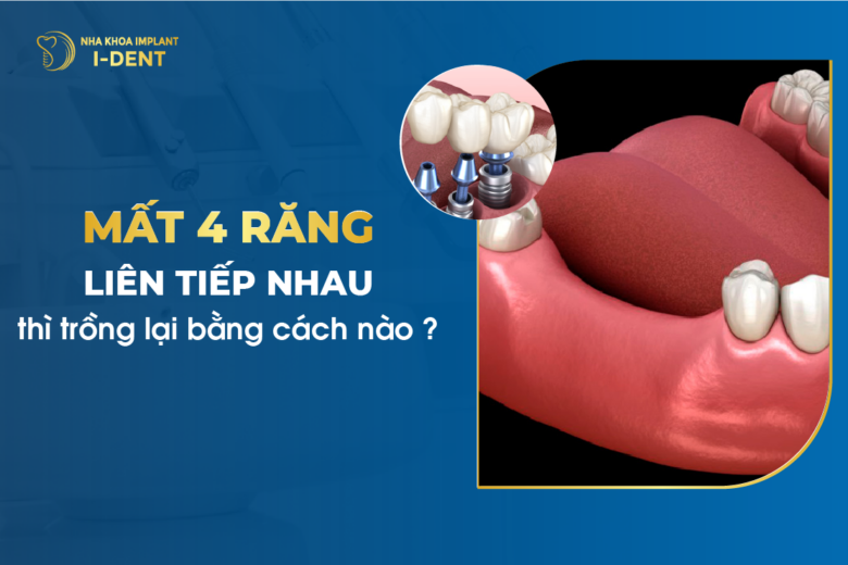 Mất 4 Răng Liên Tiếp Nhau Thì Trồng Lại Bằng Cách Nào?