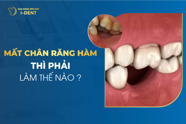 Mất Chân Răng Hàm Thì Phải Làm Thế Nào?