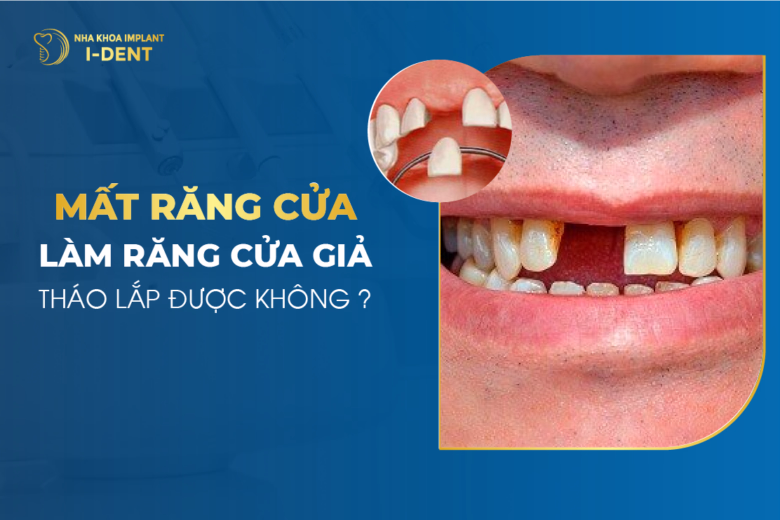 mất răng cửa
