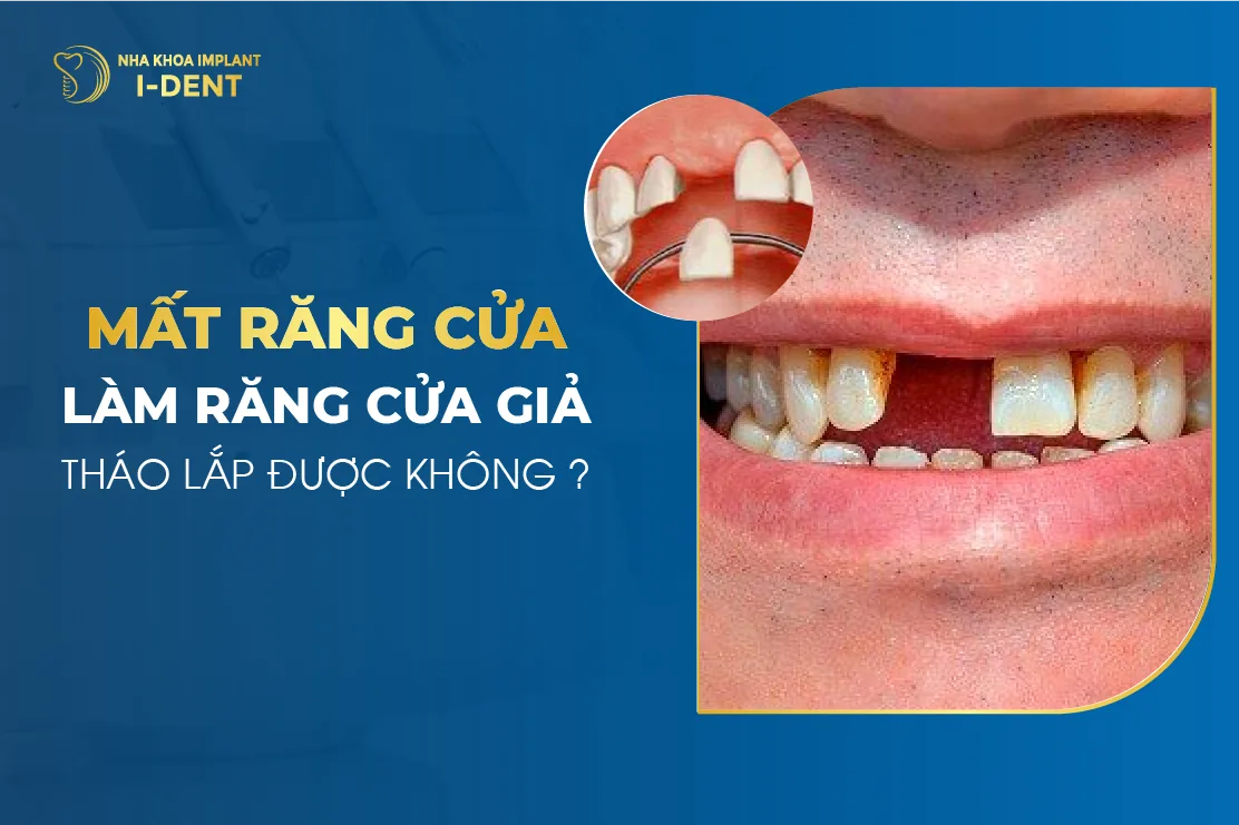 mất răng cửa