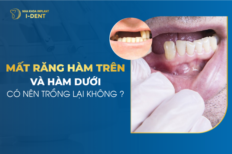trồng răng hàm