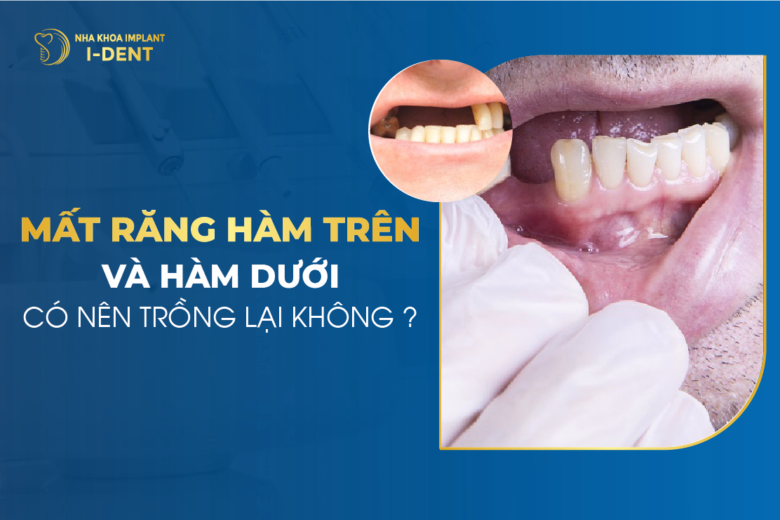 trồng răng hàm