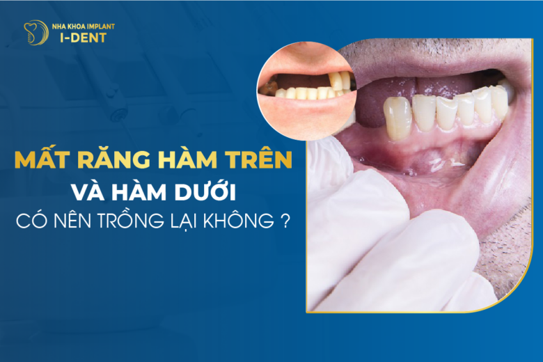 Mất Răng Hàm Trên Và Hàm Dưới Có Nên Trồng Lại Không?