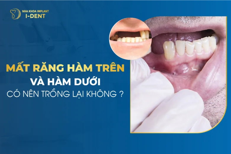 trồng răng hàm