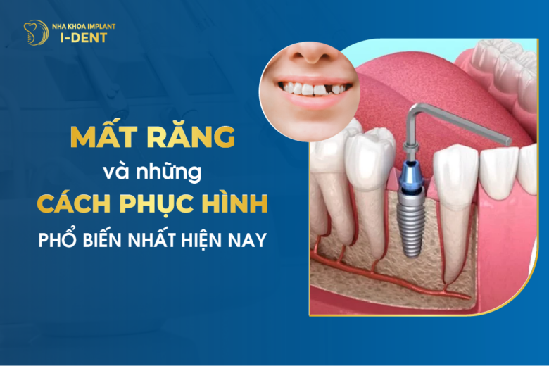 Mất Răng Và Những Cách Phục Hình Phổ Biến Nhất Hiện Nay