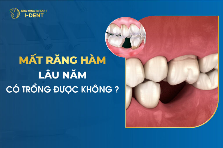 Mất răng hàm lâu năm có trồng được không