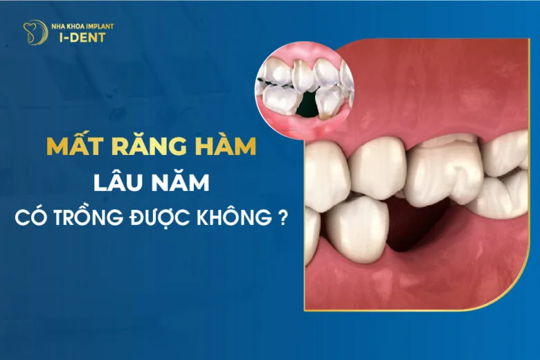Mất răng hàm lâu năm có trồng được không