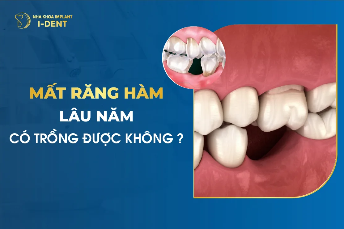 Mất răng hàm lâu năm có trồng được không