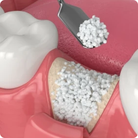 Miễn Phí Hoàn Toàn Chi Phí Ghép Xương