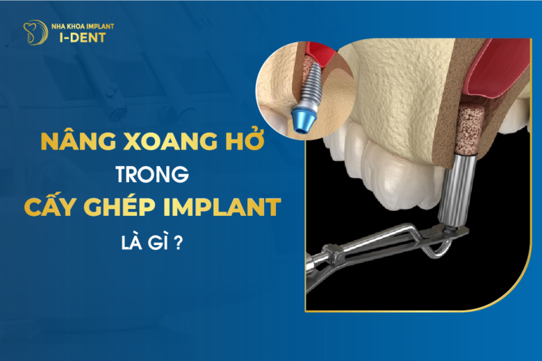 Nâng Xoang Hở Trong Cấy Ghép Implant Là Gì?