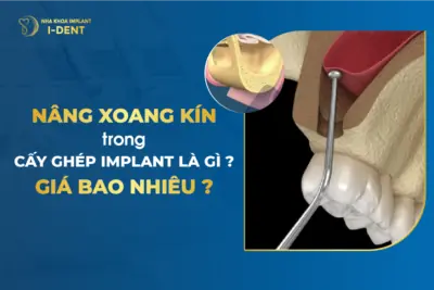 Nâng Xoang Hở Trong Cấy Ghép Implant Là Gì?