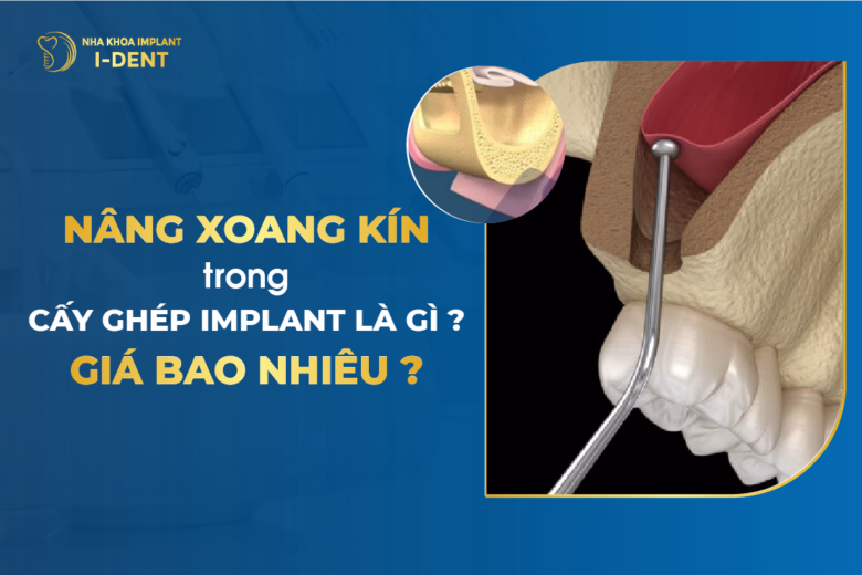 Nâng Xoang Hở Trong Cấy Ghép Implant Là Gì?