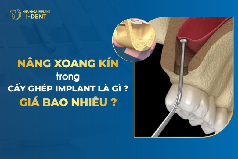 Nâng Xoang Kín Trong Cấy Ghép Implant Là Gì? Giá Bao Nhiêu?