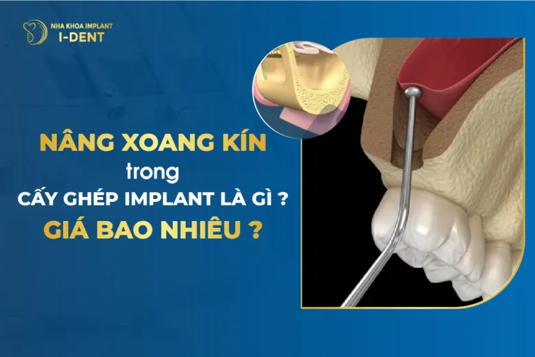 Nâng Xoang Hở Trong Cấy Ghép Implant Là Gì?