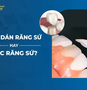 Nên Dán Răng Sứ Hay Bọc Răng Sứ-