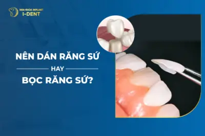 Nên Dán Răng Sứ Hay Bọc Răng Sứ-