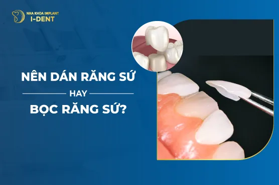 Nên Dán Răng Sứ Hay Bọc Răng Sứ-