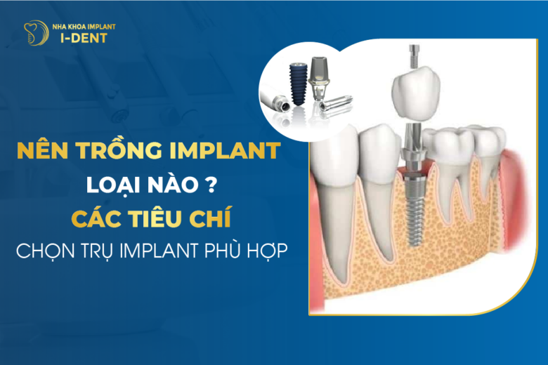 Nên Trồng Implant Loại Nào? Các Tiêu Chí Chọn Trụ Răng Implant Phù Hợp
