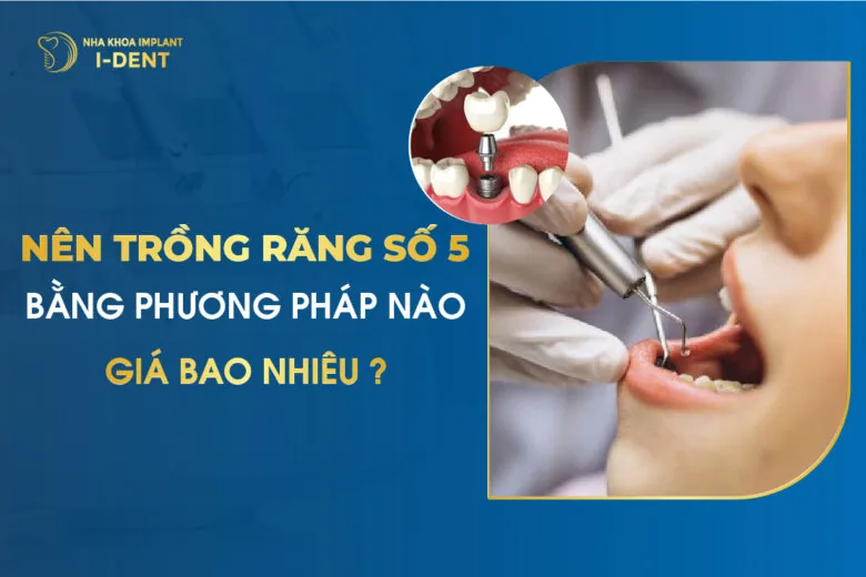 Nên trồng răng số 5 bằng phương pháp nào và giá bao nhiêu