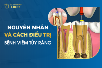 Lấy Tủy Răng Xong Nên Ăn Gì