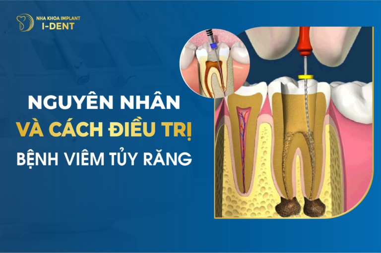 Lấy Tủy Răng Xong Nên Ăn Gì