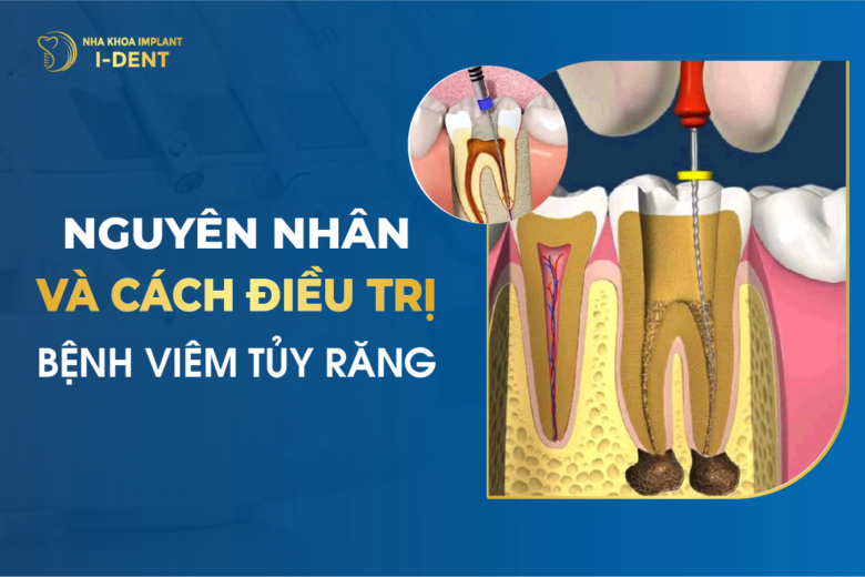 Lấy Tủy Răng Xong Nên Ăn Gì