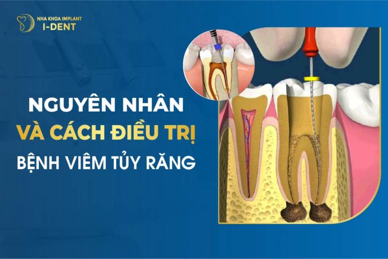 Lấy Tủy Răng Xong Nên Ăn Gì