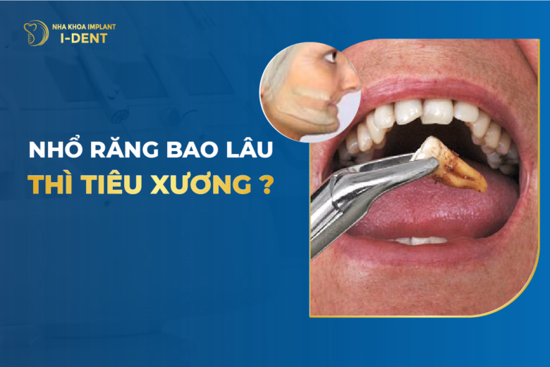 mất răng bao lâu thì bị tiêu xương hàm