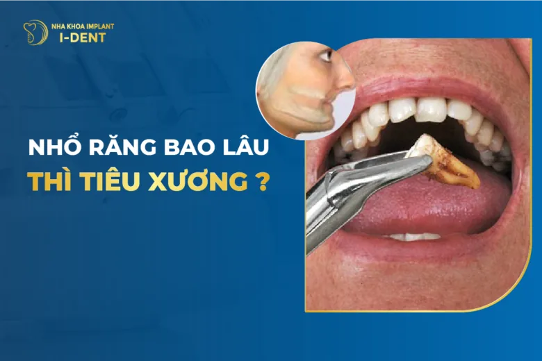 mất răng bao lâu thì bị tiêu xương hàm