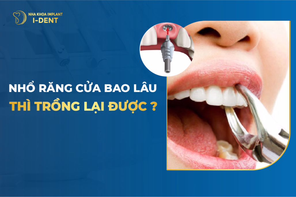 nhổ răng bao lâu thì trồng lại được