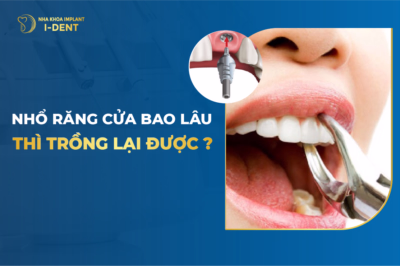 nhổ răng bao lâu thì trồng lại được